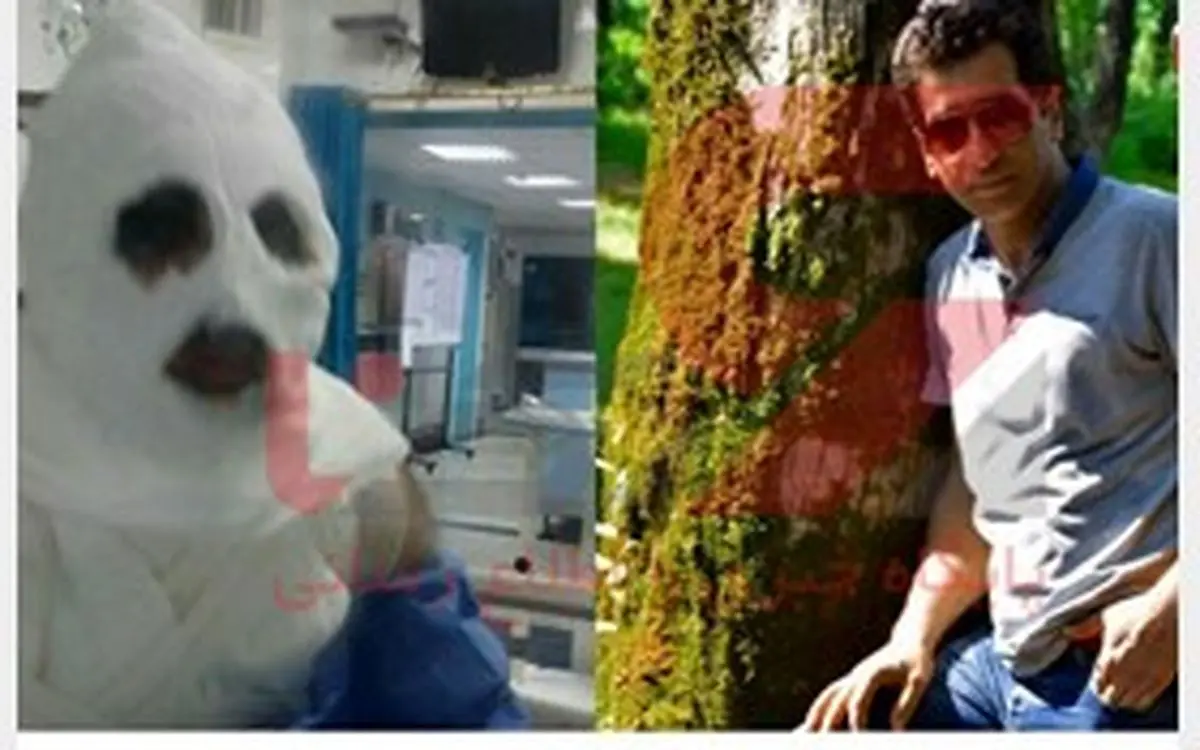 اسید پاشی مرد همسایه بر روی یک زوج آملی