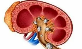 درمان سریع سنگ کلیه بدون نیاز به دارو