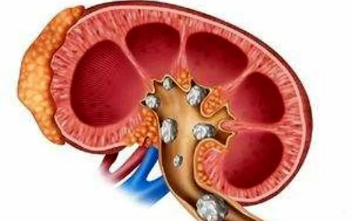 درمان سریع سنگ کلیه بدون نیاز به دارو
