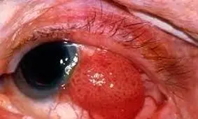 سرطان چشم؛ مرگی بدون درد