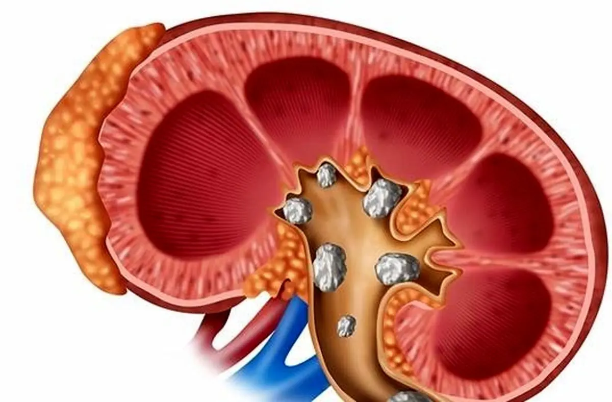 چگونه با درمان سریع سنگ کلیه را درمان کنیم؟