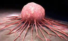 ۵ افسانه مدرن درباره سرطان/از تومور مغزی دایناسور‌ها تا بازی ساده‌ای که سرچشمه نگرانی‌ها شد!