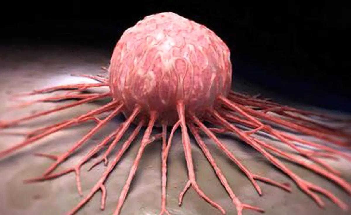 ۵ افسانه مدرن درباره سرطان/از تومور مغزی دایناسور‌ها تا بازی ساده‌ای که سرچشمه نگرانی‌ها شد!