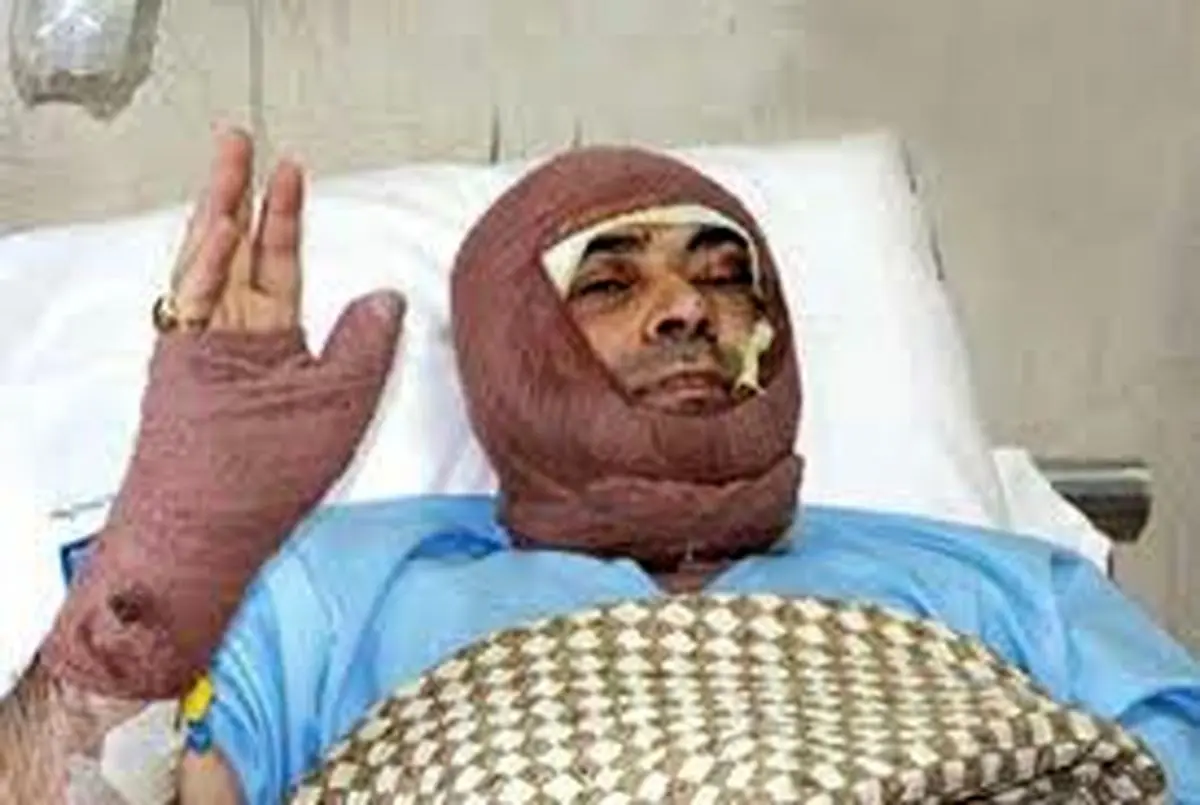 اسیدپاشی زن انتقامجو به صورت مرد آشنا در اهر