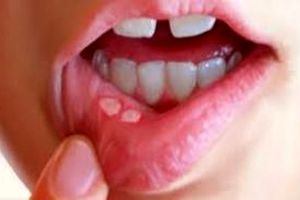 چه عواملی باعث ایجاد آفت دهان می‌شود؟