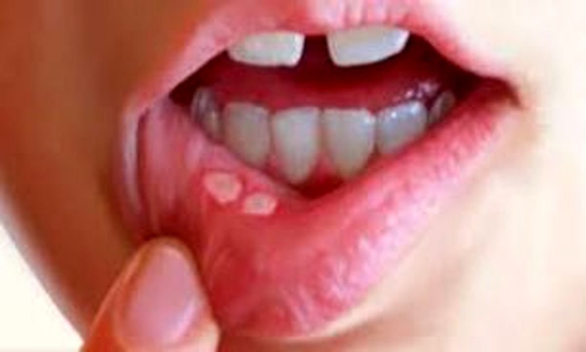 چه عواملی باعث ایجاد آفت دهان می‌شود؟