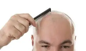 ریزش مو نشانه کدام بیماری است؟