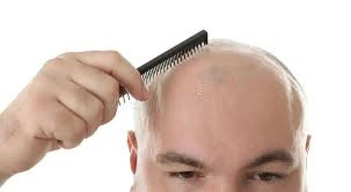 ریزش مو نشانه کدام بیماری است؟