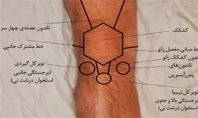 نوعی بیماری عجیب استخوانی/توده‌ای که در ران پا رشد می‌کند