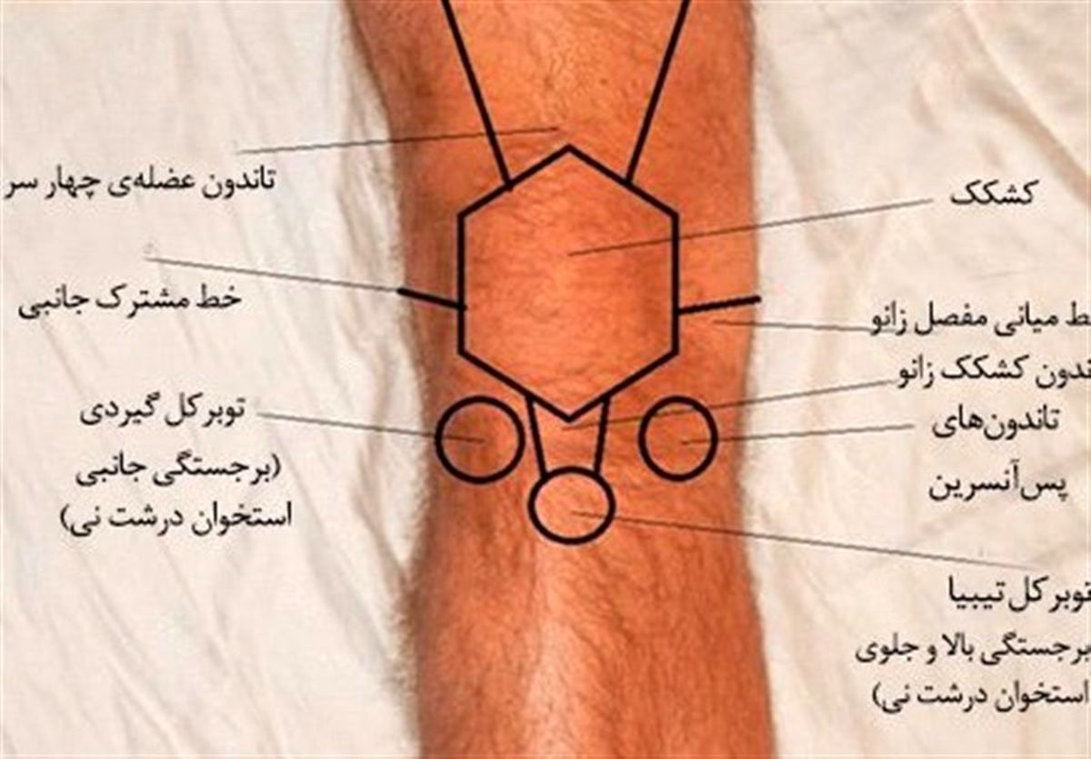 نوعی بیماری عجیب استخوانی/تودهای که در ران پا رشد میکند