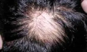 بیماری تريكوتيلومانيا را بیشتر بشناسید