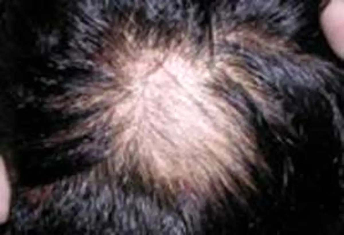 بیماری تريكوتيلومانيا را بیشتر بشناسید