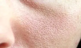 ترفند طبیعی و معجزه آسا برای درمان منافذ باز پوست+ دستور تهیه