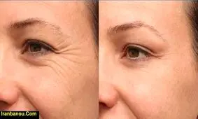 چین و چروک دور چشم / راه های خانگی اعجاب انگیز و موثر بر آن