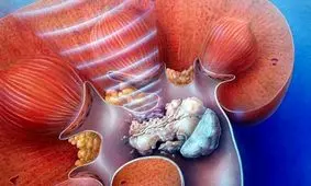 ۱۰ علت ایجاد سنگ کلیه که باید بدانید!