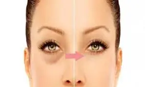 روشی سریع و معجزه آسا برای درمان سیاهی زیر چشم