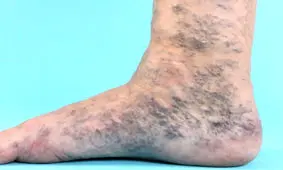 هرآنچه باید درباره واریس و راه‌های درمانش بدانید