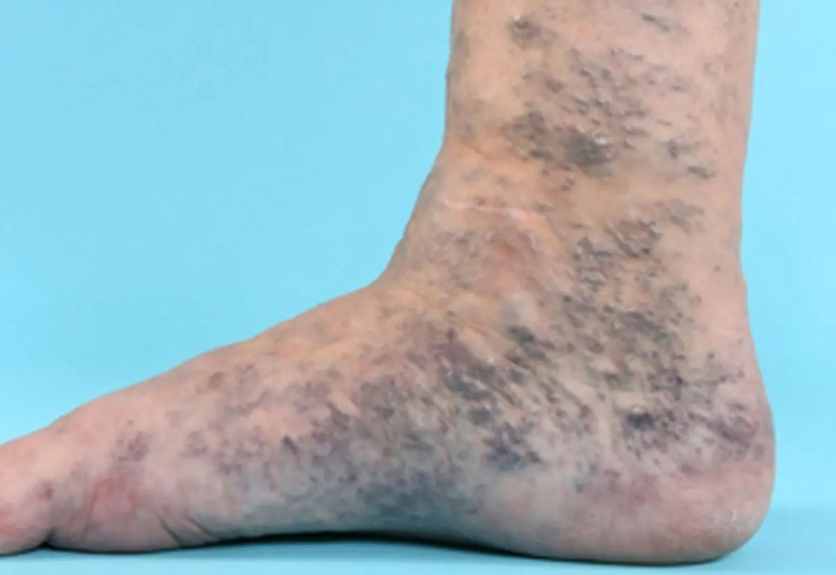 هرآنچه باید درباره واریس و راه‌های درمانش بدانید