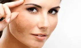 درمان ملاسما روی پوست با روش های خانگی فوق العاده