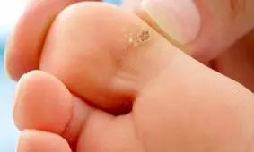 چگونگی درمان و پیشگیری از زگیل ها با رژیم غذایی