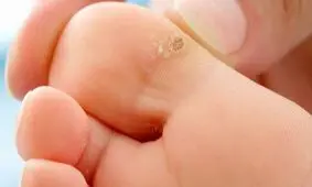 چگونگی درمان و پیشگیری از زگیل ها با رژیم غذایی
