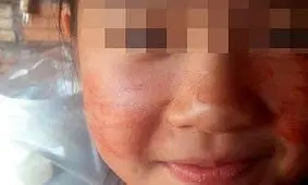 این دختر خون عرق می کند! + عکس