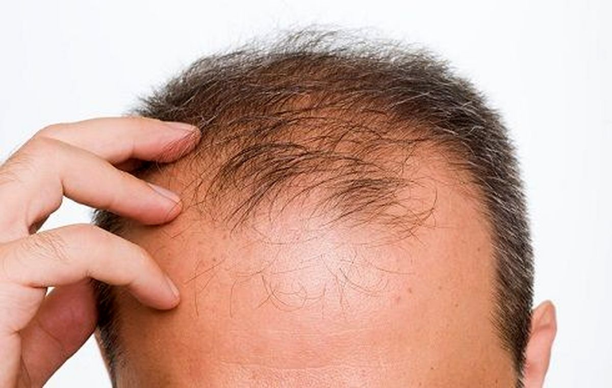 وقتی گیاهان دارویی شما را از شر طاسی نجات میدهند!