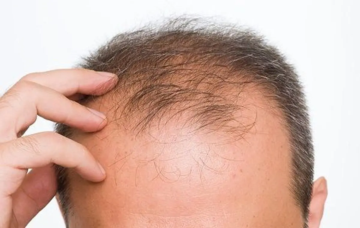 وقتی گیاهان دارویی شما را از شر طاسی نجات می‌دهند!