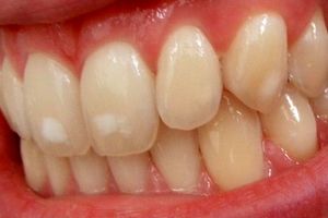 راهکار محققان دانشگاه امیرکبیر در بهبود عملکرد ایمپلنت دندانی