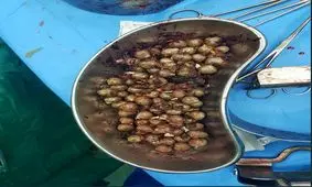 کشف 84 بسته هروئین از معده یک قاچاقچی + عکس