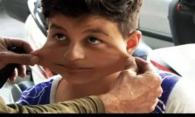 داروی بسیار گران بیماران sma تولید داخلی می‌شود