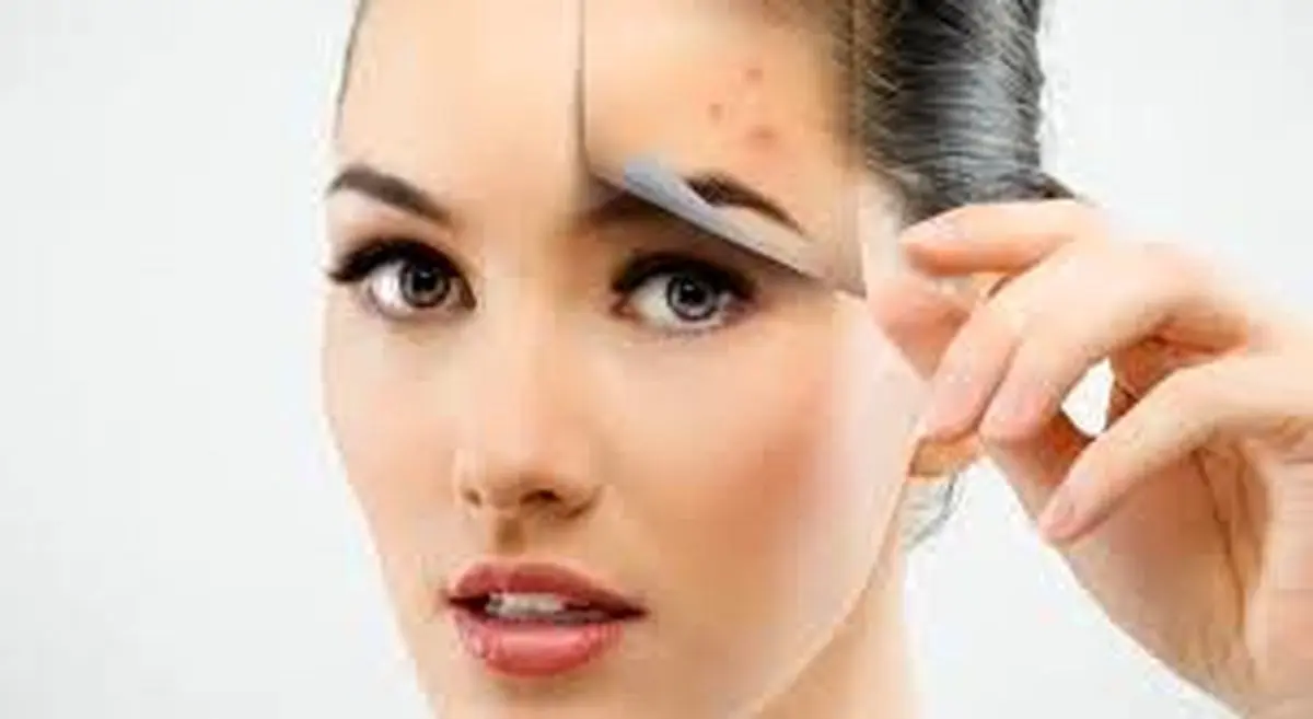 درمان معجزه آسا برای جوش صورت