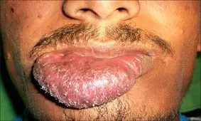 بیماری ناشناخته‌ای که زبان را از حلقومتان بیرون می‌کشد+ تصاویر