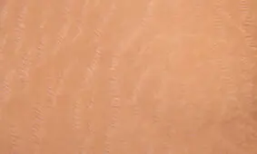 دلیل ترک خوردگی پوست بدن را بدانید!