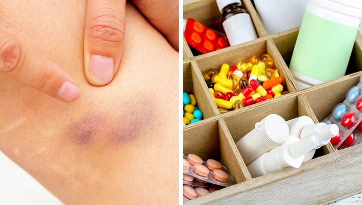 وقتی کبودیهای بدن به شما درباره سلامیتان هشدار میدهند!