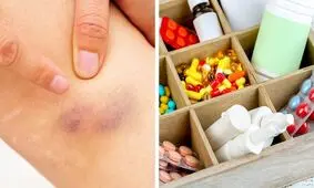 وقتی کبودی‌های بدن به شما درباره سلامیتان هشدار می‌دهند!
