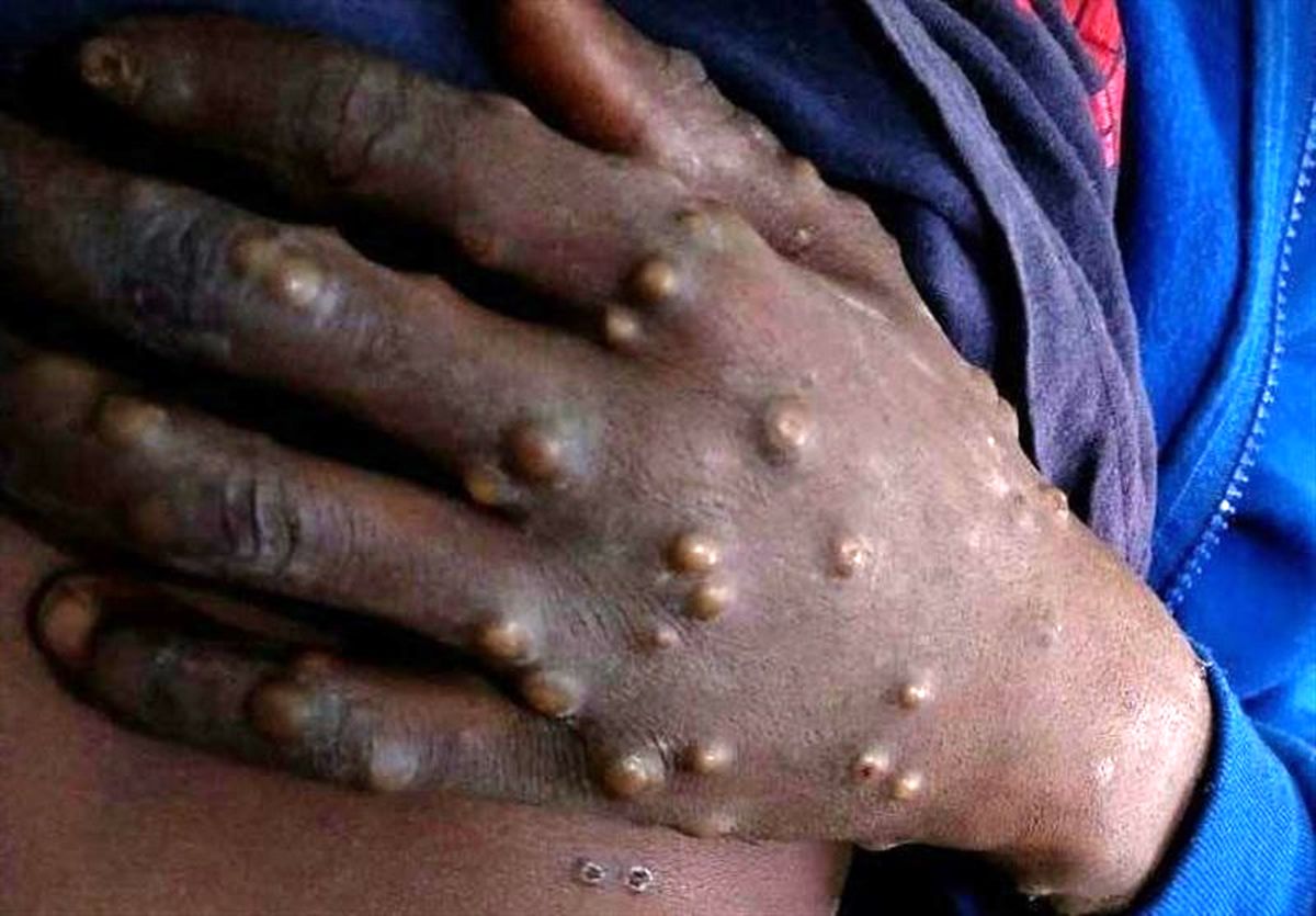 شیوع بیماری آبله میمونی پس از نیجریه در انگلیس