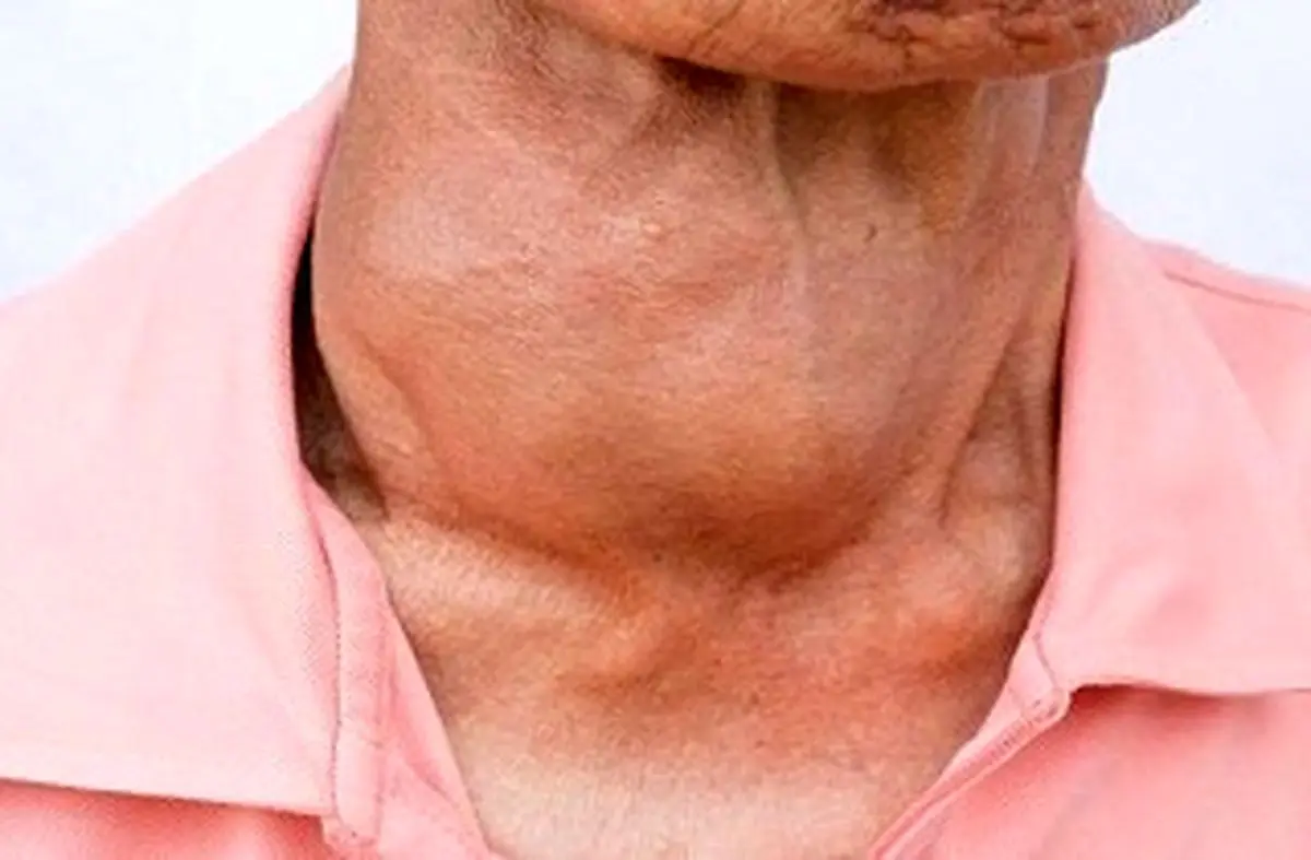 چگونه کم کاری تیروئید را تشخیص دهیم؟