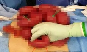 کشف عجیب بادکنک پر از آب داخل شکم پسر جوان + تصاویر