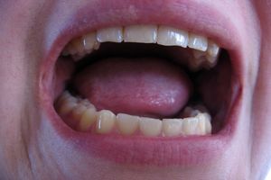 وقتی خشکی دهان سلامت دندان هایتان را تهدید می‌کند!