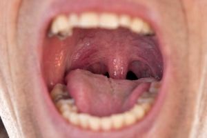 علت تورم سقف دهان چیست؟