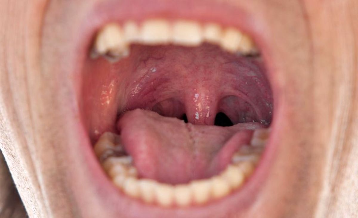 علت تورم سقف دهان چیست؟