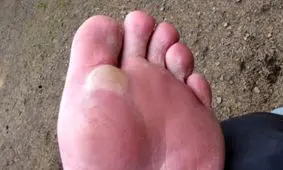 نحوه پیشگیری و درمان تاول