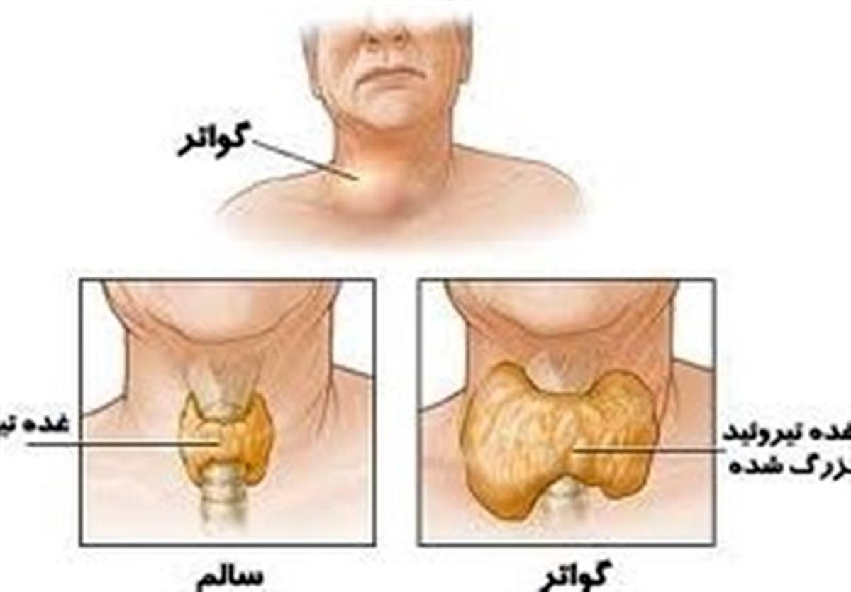 زیان ناآشنایی جامعه با علائم سرطان تیروئید/ مراقب تغییر صدا و گره گردنتان باشید