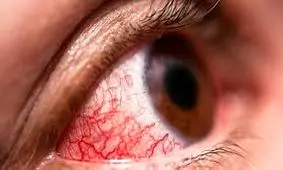 نقش رگ های خونی تازه شکل گرفته در بیماری های چشمی