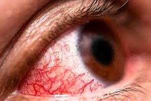 نقش رگ های خونی تازه شکل گرفته در بیماری های چشمی