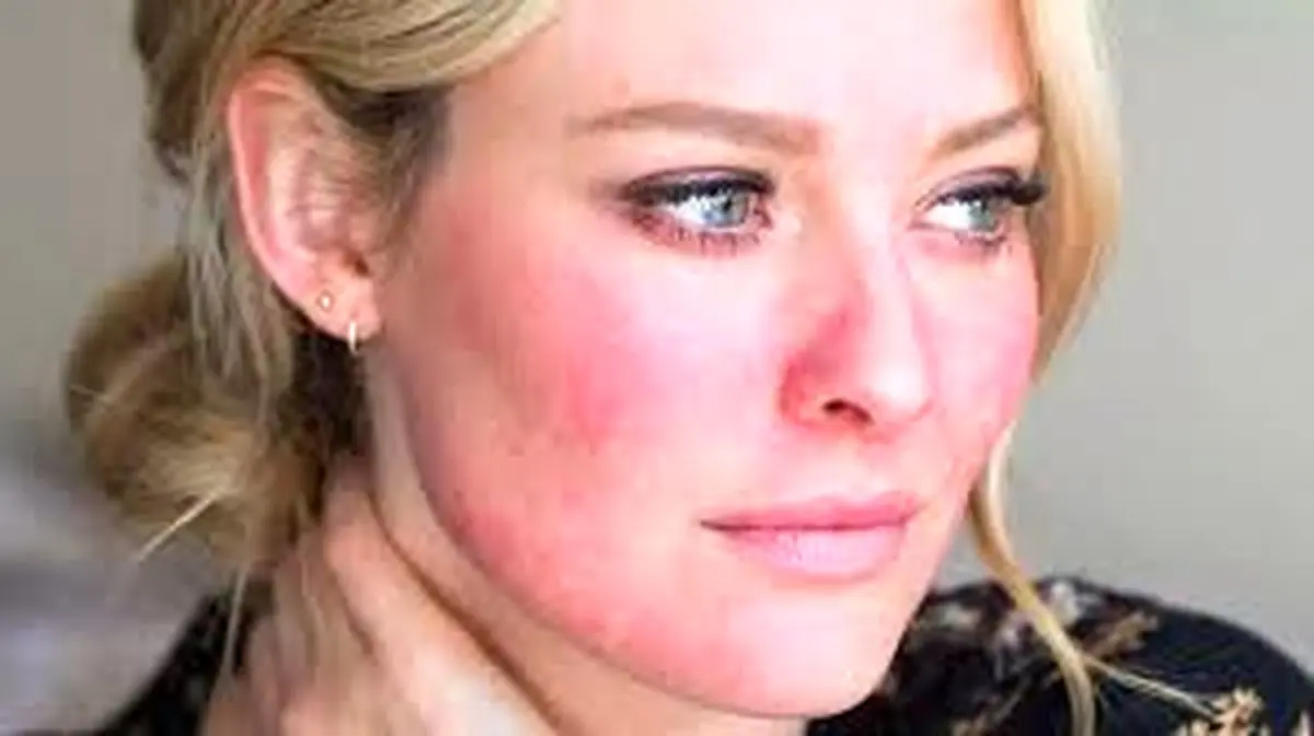 این بیماری پوستی باعث افزایش خطر ابتلا به آلزایمر می‌شود