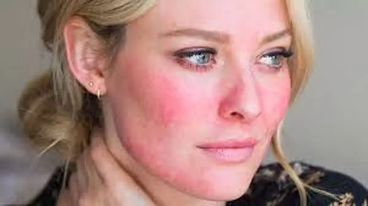 این بیماری پوستی باعث افزایش خطر ابتلا به آلزایمر می‌شود