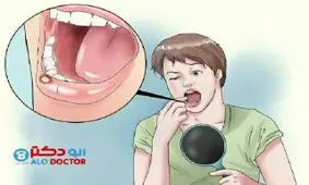 درمان آفت دهان