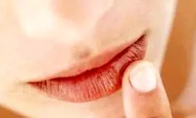 اگر در زمستان دچار خشکی لب هستید